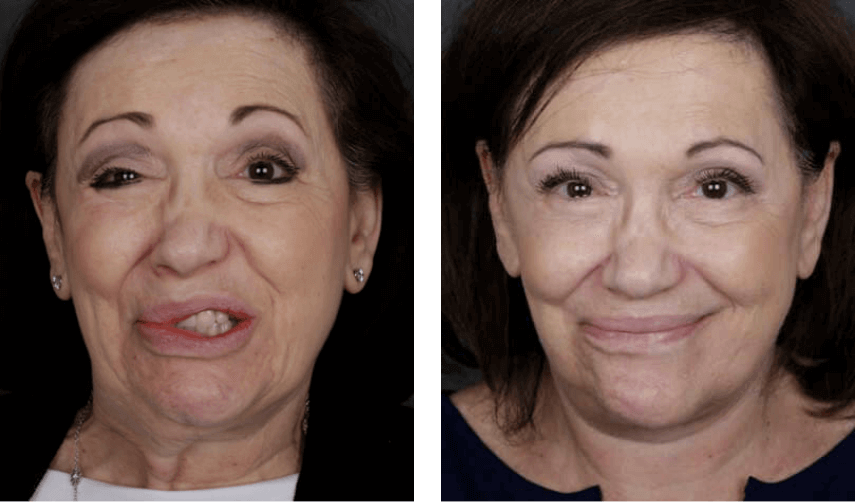 Physical Therapist's Guide to Bell's Palsy